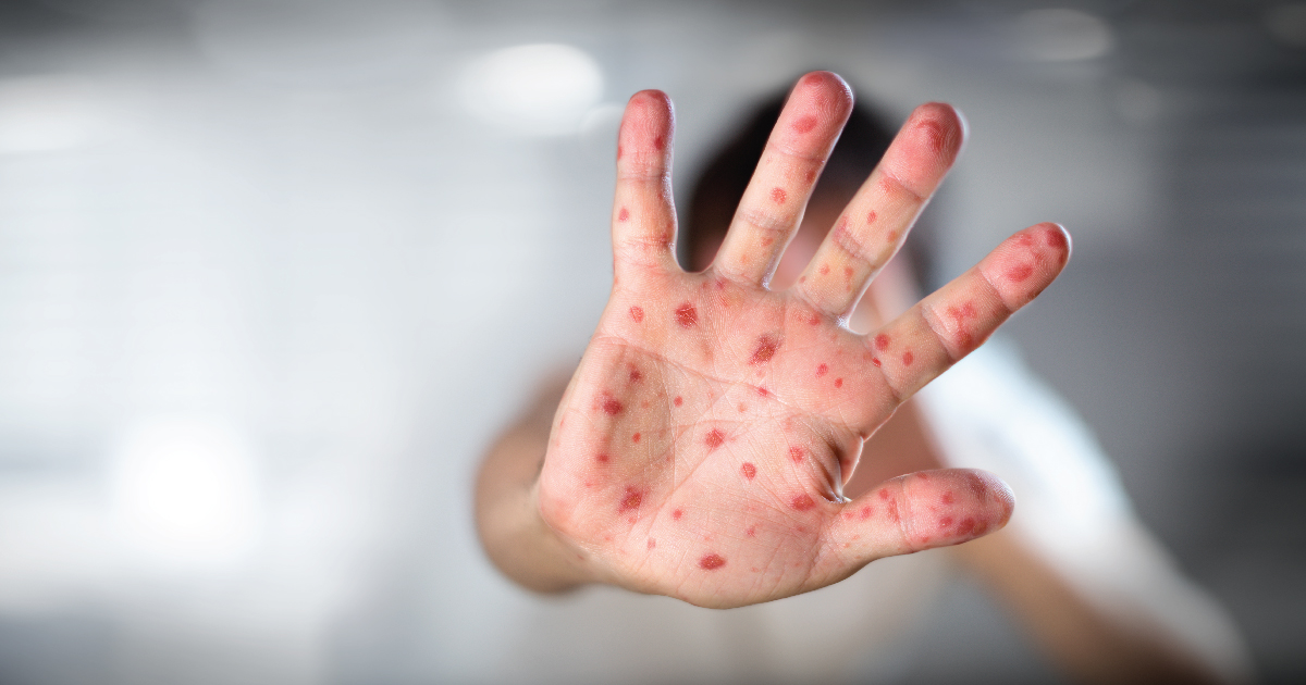 Male boginje - sve što treba da znate o Morbili virus-u