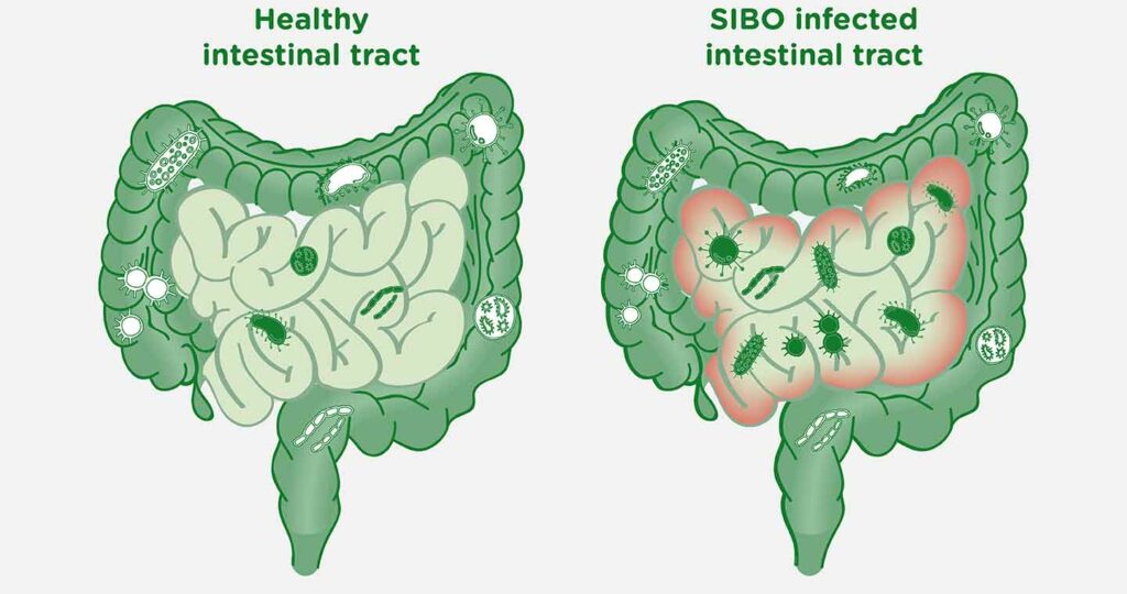 SIBO 