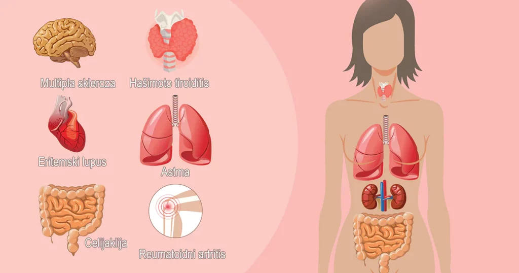 Autoimune bolesti kao mogući uzročnici problema sa začećem 6
