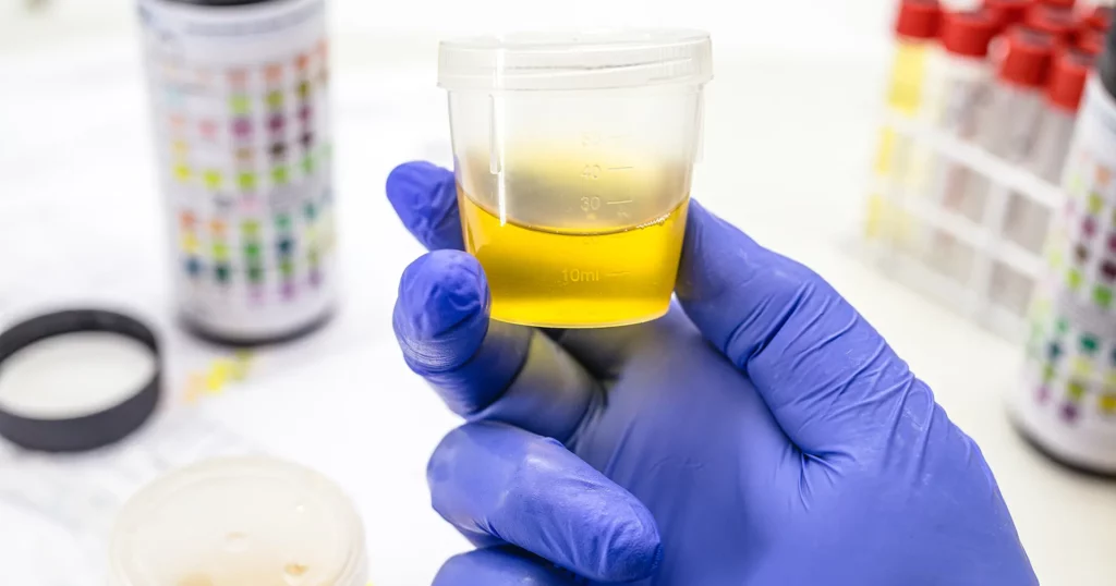 Analiza urina i urinokultura 1