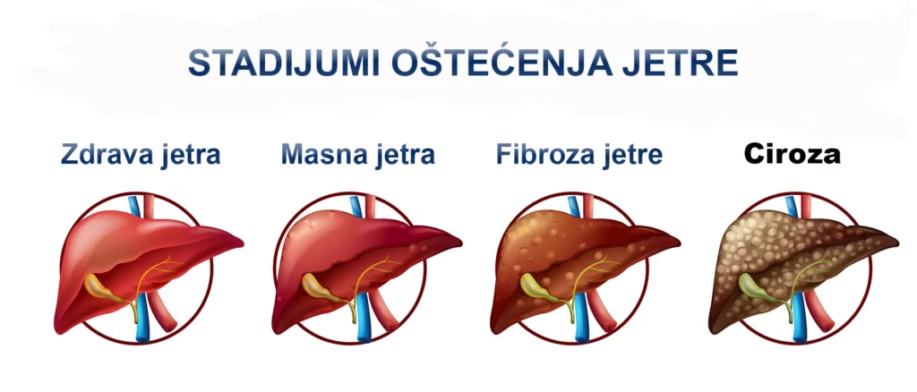 Uzroci i simptomi bolesti jetre 2