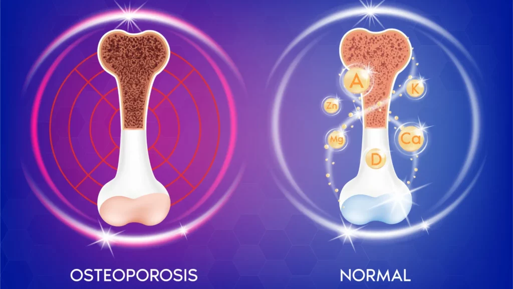 Osteoporoza simptomi, uzroci, faktori rizika 9