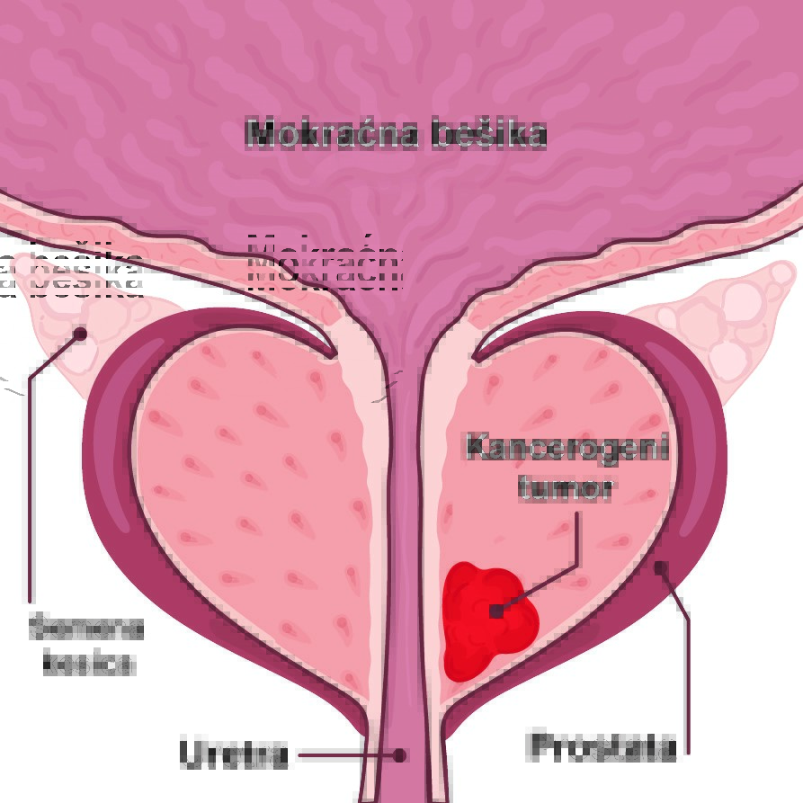 Oboljenja prostate-simptomi, dijagnoza i laboratorijski testovi 3