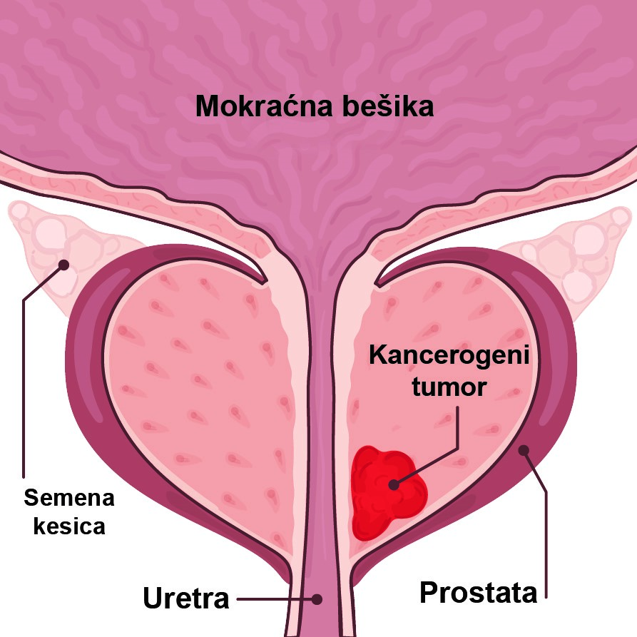 Oboljenja prostate-simptomi, dijagnoza i laboratorijski testovi 9