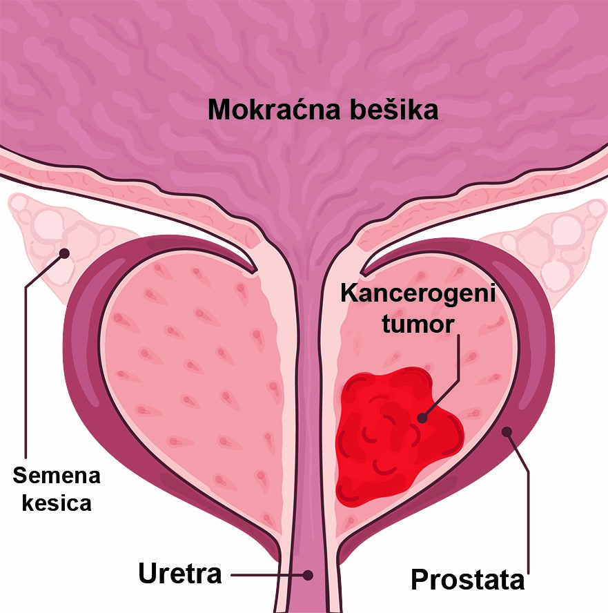 Oboljenja prostate-simptomi, dijagnoza i laboratorijski testovi 10