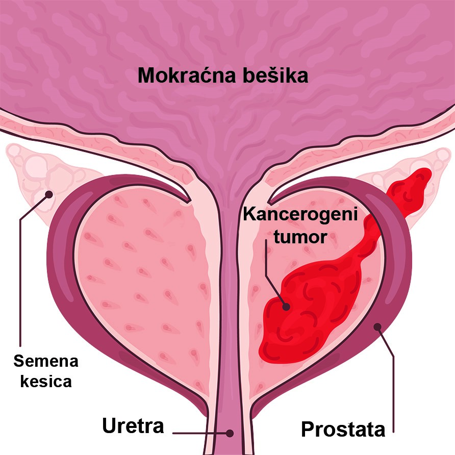 Oboljenja prostate-simptomi, dijagnoza i laboratorijski testovi 11