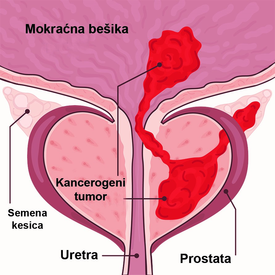 Oboljenja prostate-simptomi, dijagnoza i laboratorijski testovi 12