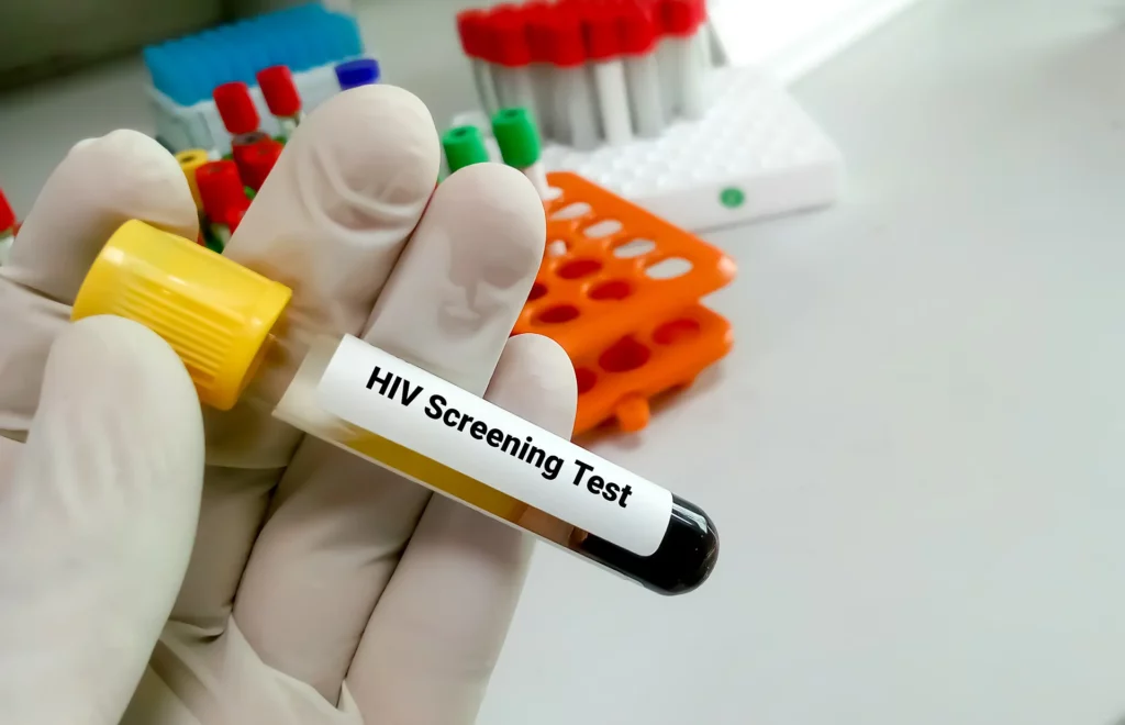 Kada-se-radi-testiranje-na-HIV?