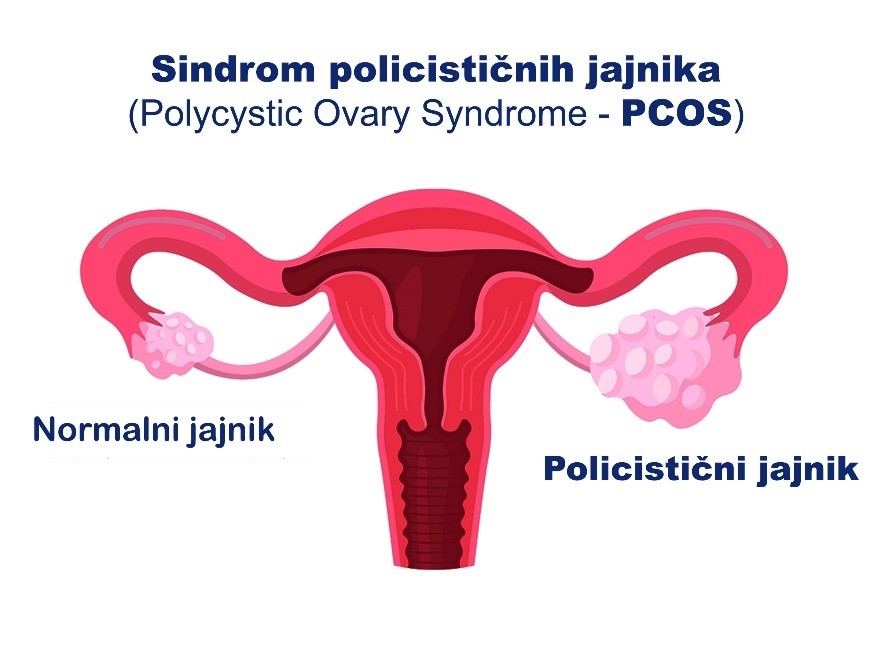 sindrom policisticnih jajnika PCOS