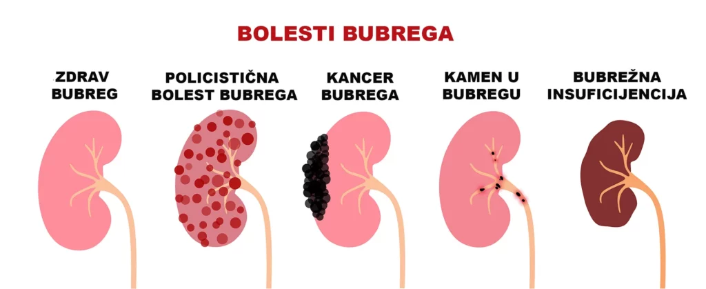 Bolesti bubrega – simptomi, uzroci, dijagnostika i terapija 3