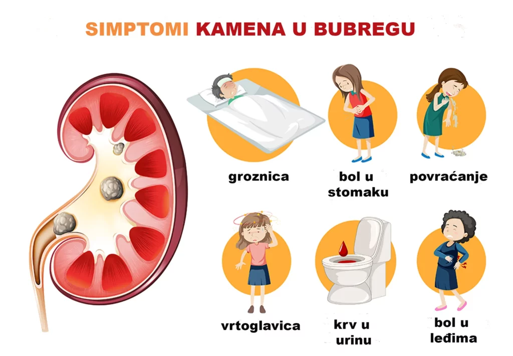 Bolesti bubrega – simptomi, uzroci, dijagnostika i terapija 2