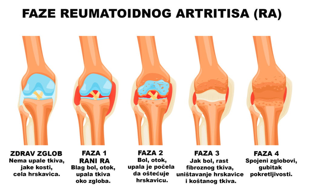 Reumatoidni artritis – simptomi, uzroci, dijagnostika i terapija 4