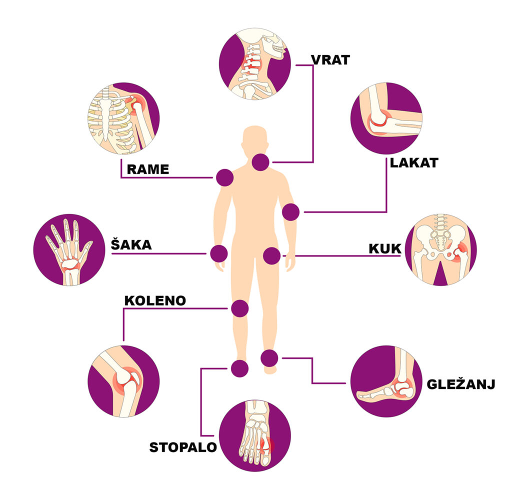 Reumatoidni artritis – simptomi, uzroci, dijagnostika i terapija 1