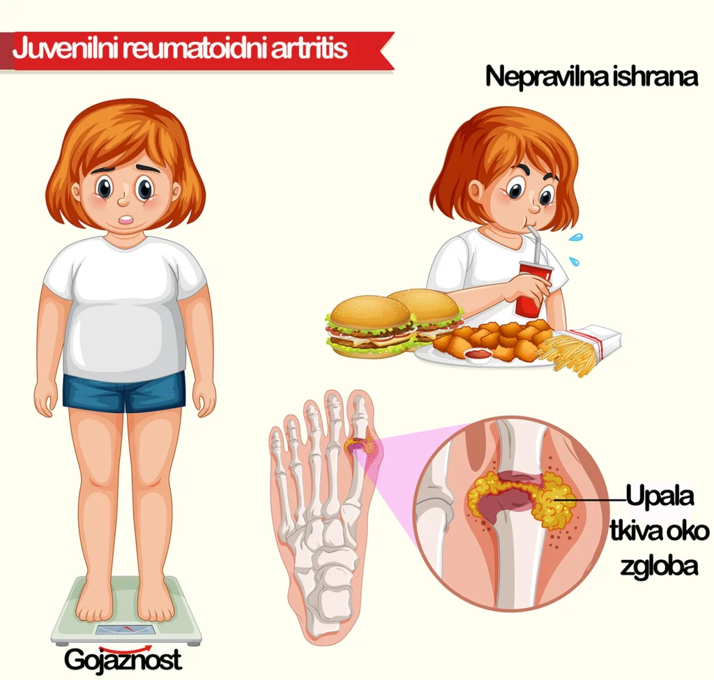 Juvenilni (dečiji) reumatoidni artritis – tipovi, simptomi, dijagnostika i terapija 3