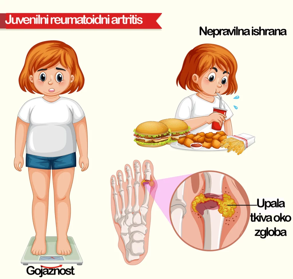 Juvenilni (dečiji) reumatoidni artritis – tipovi, simptomi, dijagnostika i terapija 39