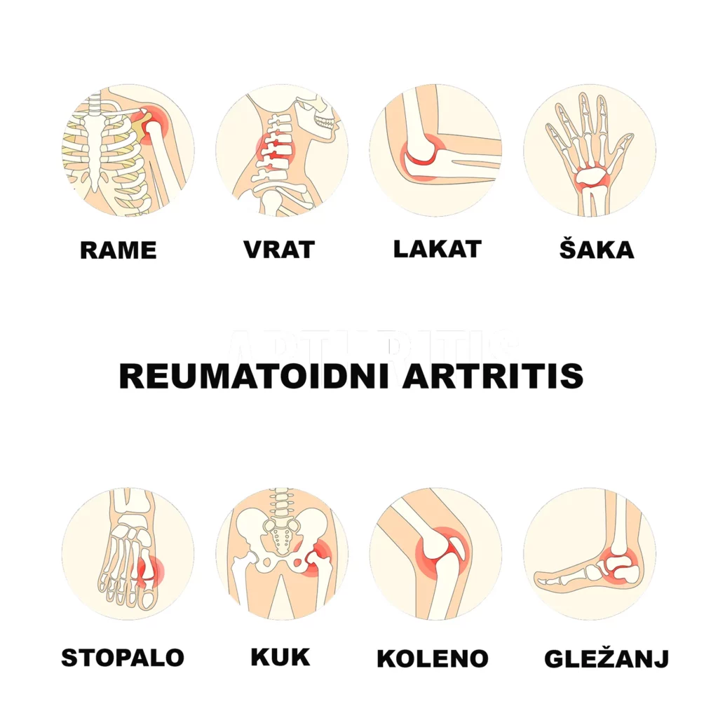 Juvenilni (dečiji) reumatoidni artritis – tipovi, simptomi, dijagnostika i terapija 1