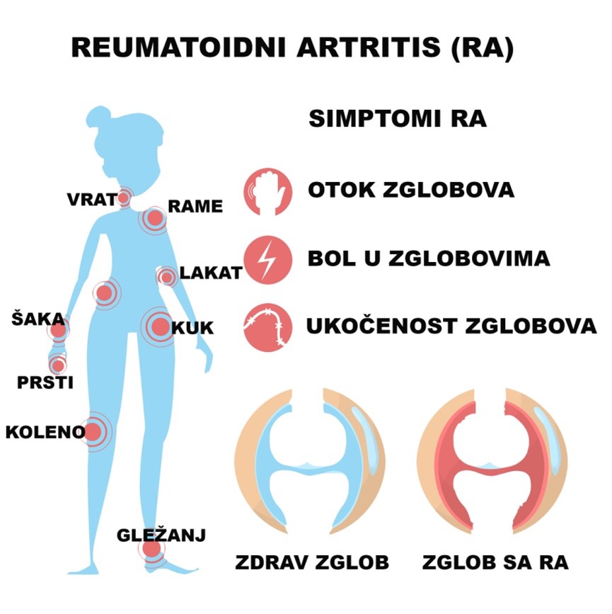 Reumatoidni artritis i trudnoća 1
