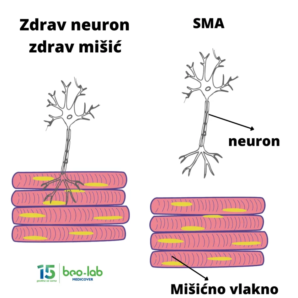 Spinalna mišićna atrofija-simptomi, uzrok nastanka, postavljanje dijagnoze i lečenje 3