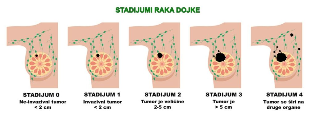 Stadijumi raka dojke