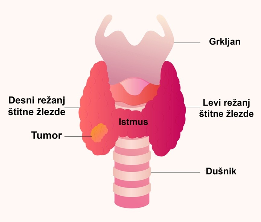 Rak štitne žlezde, klinička i laboratorijska dijagnostika 1