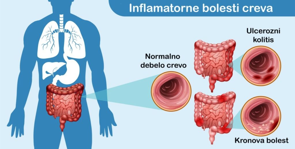 Tipovi inflamatornih bolesti creva